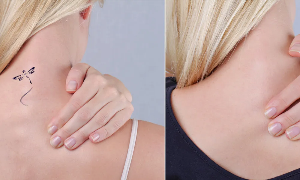 laser tattoo removal